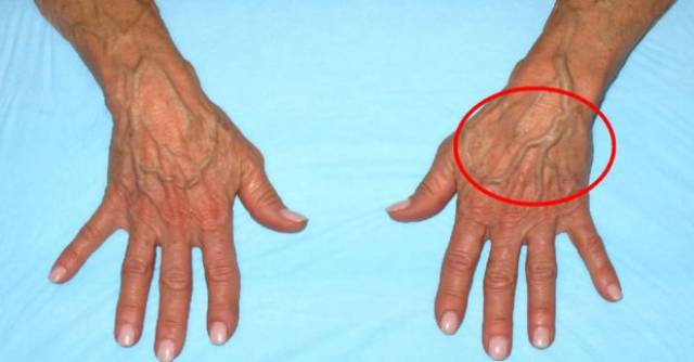 成人手指青筋,不但提示消化系统有问题,还反映了头部血管微循环障碍
