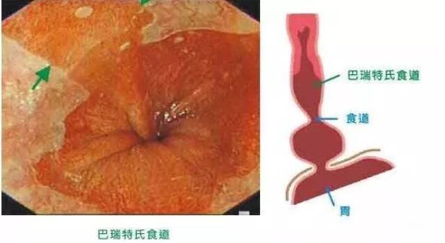 巴雷特食管图片怎么看图片