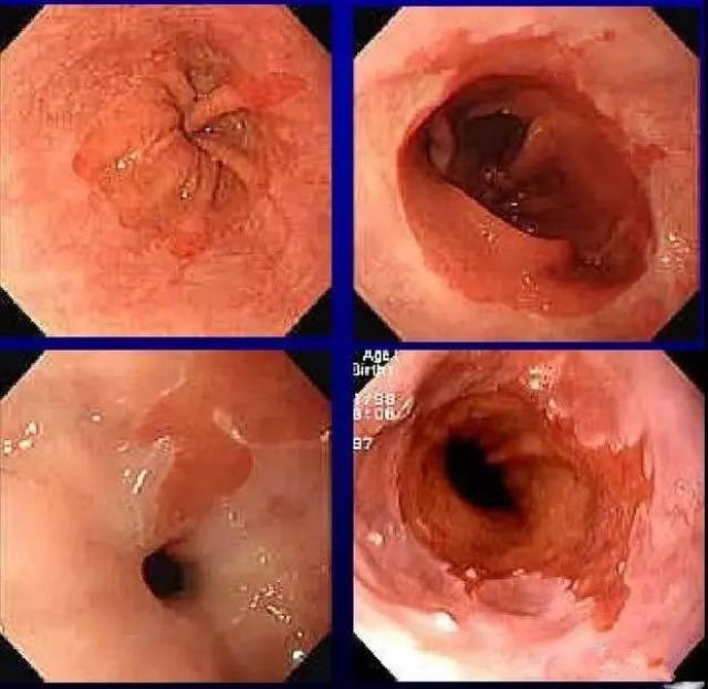 barrett食管(巴雷特)是不是癌?怎么诊断和治疗?