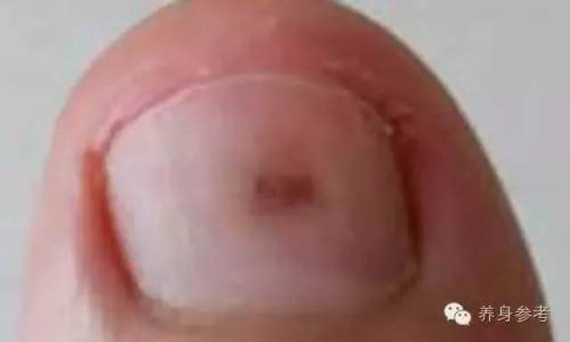 指甲长成这样,可能是癌症的信号?发生这些变化,不要忽视!