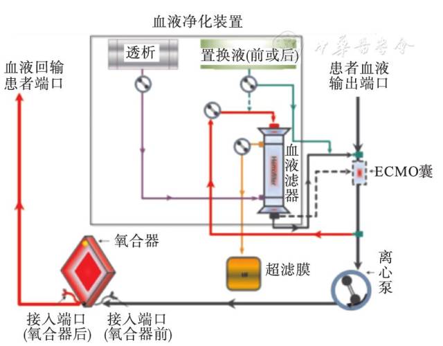 crrt從ecmo滾壓泵前引血,經濾器濾過後血液回到ecmo離心泵前或ecmo血