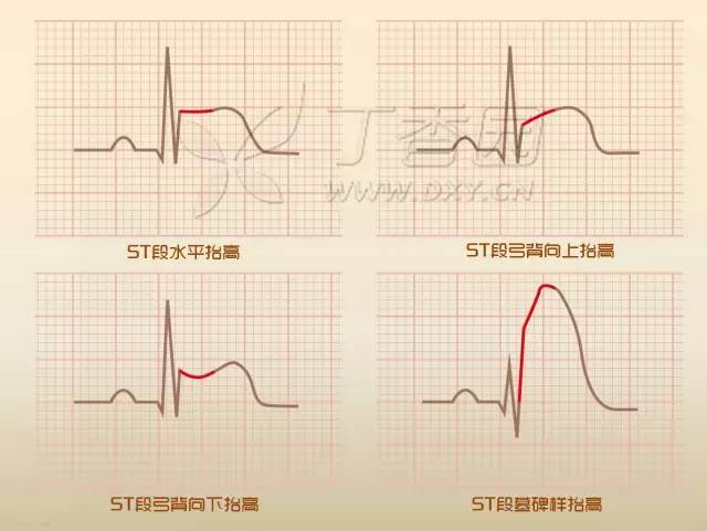 st弓背向下抬高图片