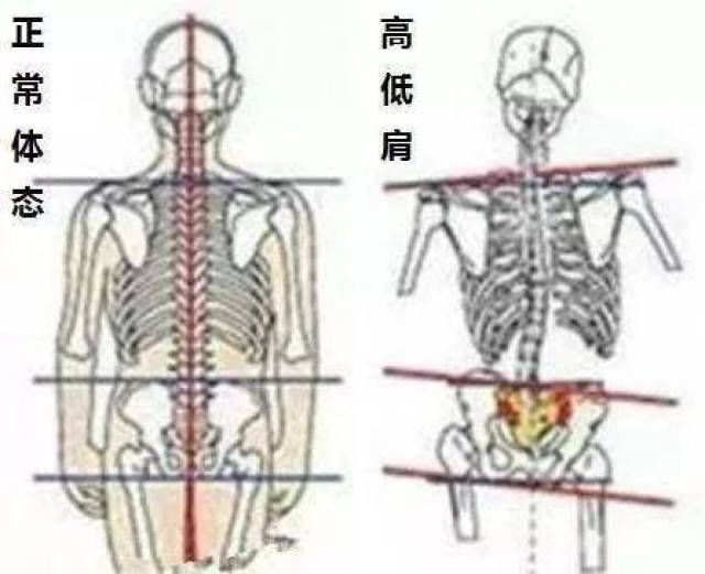 駝背,高低肩,扁平足,八字腳,脊柱側彎,專家教你運動