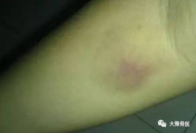 掌握正确的按压手法让你摆脱抽血后淤青