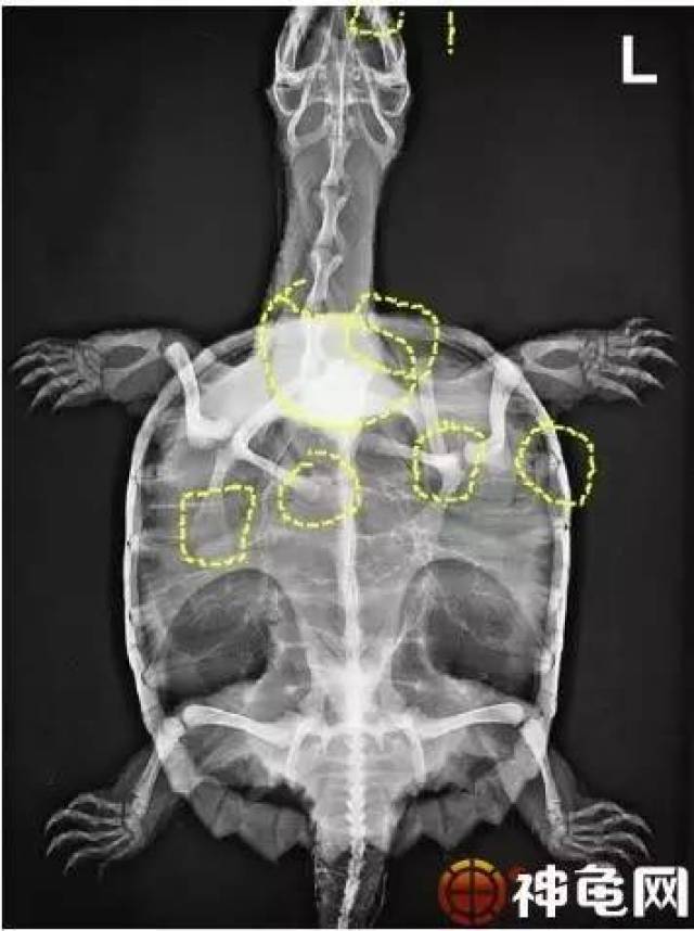 用x光辅助诊断龟病,更精准找出病因