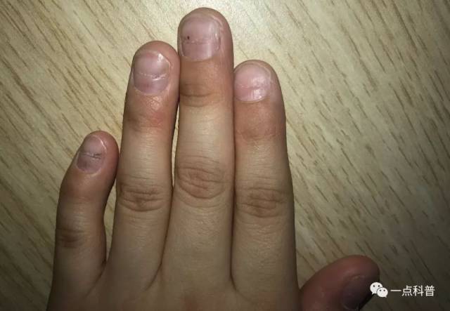 孩子十个指甲都有横纹,是缺乏维生素吗?