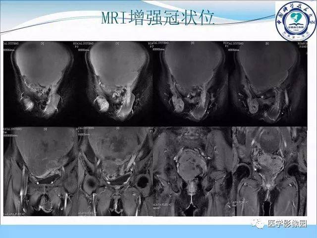 男性假兩性畸形腹部腫塊等你分析讀片專欄824期