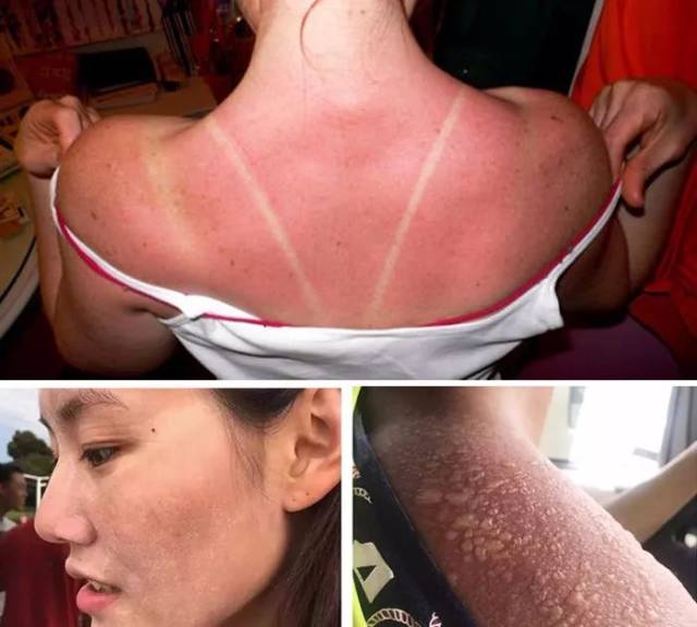 同样的, 晒伤, 晒裂肌肤的病人也有 百万之多, 直接晒出  脱皮, 褐鬃