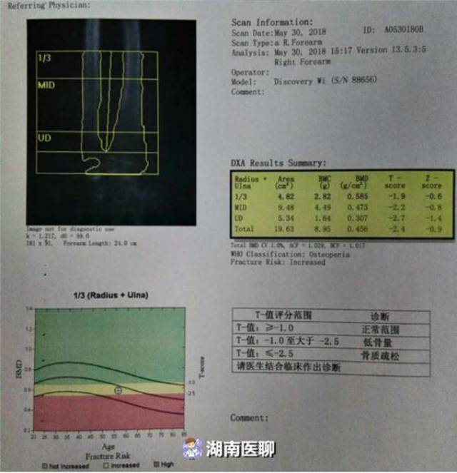 58岁大妈背部疼痛进医院,医生说,这两项骨密度检查不能少!