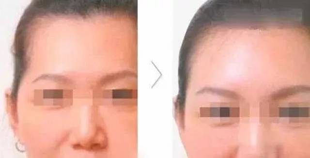 干货 | 颞区脂肪室的应用解剖_手机搜狐网