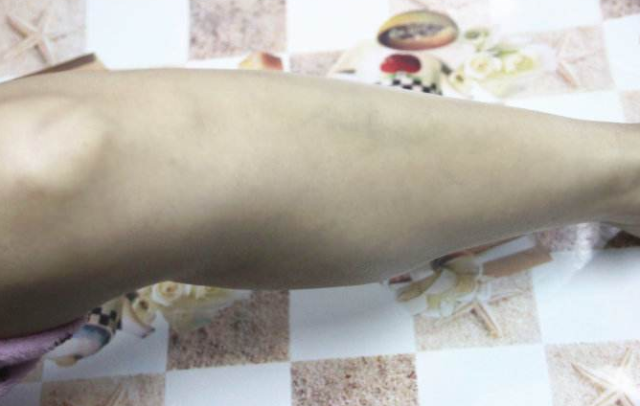 宝妈孕期和产后都不活动,小心静脉血栓找上你,后果很严重