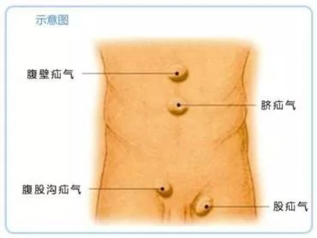 腹股沟淋巴结症状图片
