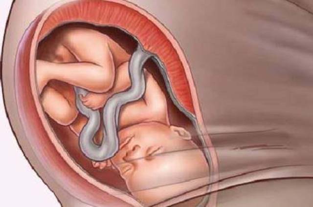 肚子最大的孕妇入盆图片