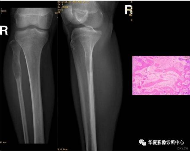 【推薦收藏】腓骨頭及腓骨上端骨腫瘤(圖文並茂)