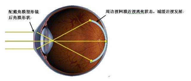 角膜塑形镜控制近视发展的原理是什么?