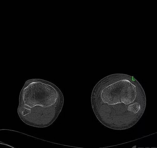 胼胝体膝部ct图片图片