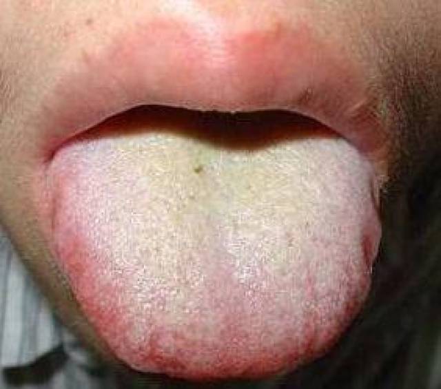 如果舌苔粗糙或很厚,发黄发腻,则说明体内有湿热