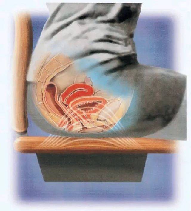 康复兵器谱丨盆底康复新武器——磁刺激