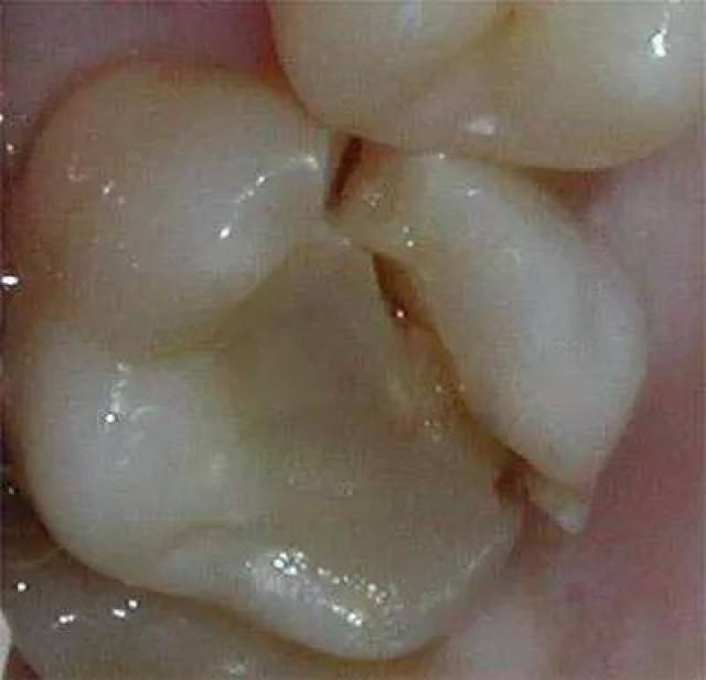 牙齿骨开裂图片图片