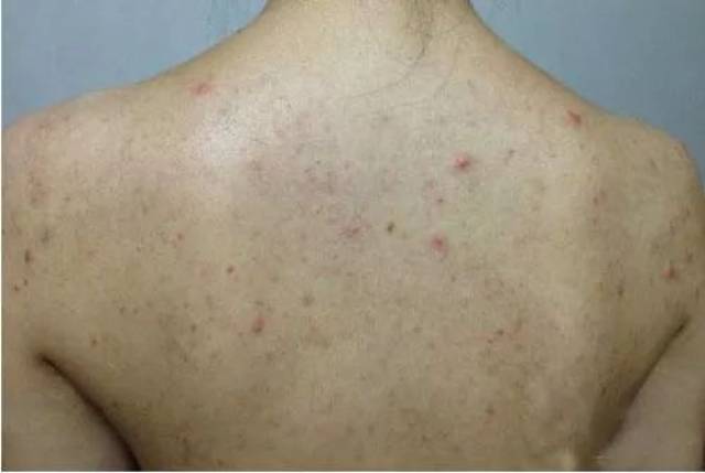 胯部长鸡皮肤(胯部长鸡皮肤怎么回事) 胯部长鸡皮肤(胯部长鸡皮肤怎么回事)