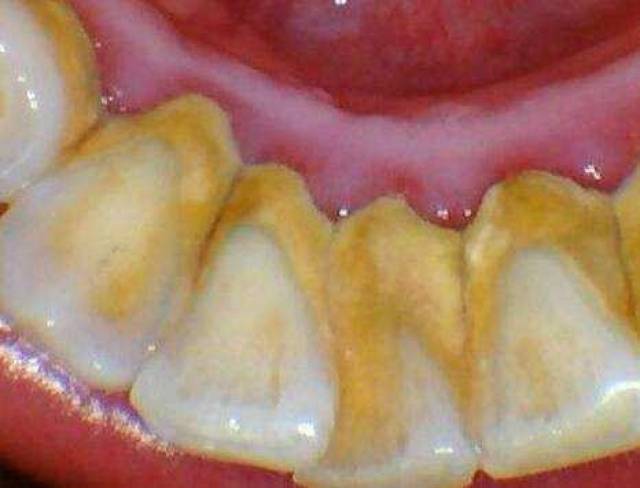一文看懂:牙垢和牙结石的成因和危害性区别