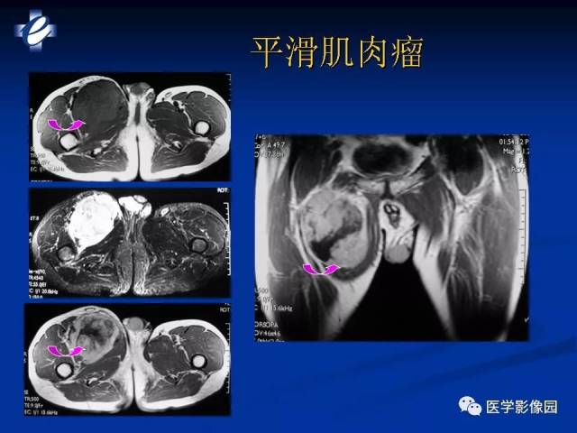 mri軟組織腫瘤的影像診斷 | 影像天地