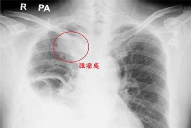 胸x线透视:可以早期发现肺结核,肺癌,尤其是常年嗜烟者更应定期做胸透