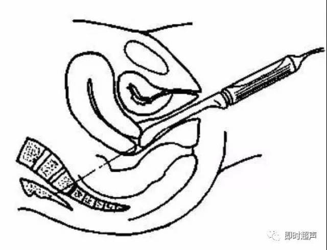 阴超,也就是阴道b超,又称腔内b超,是将b超探头放入阴道或者直肠进行