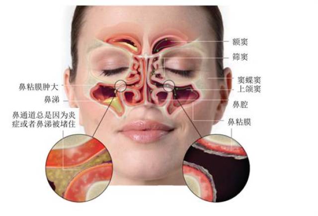 鼻窦炎和正常人的图片图片