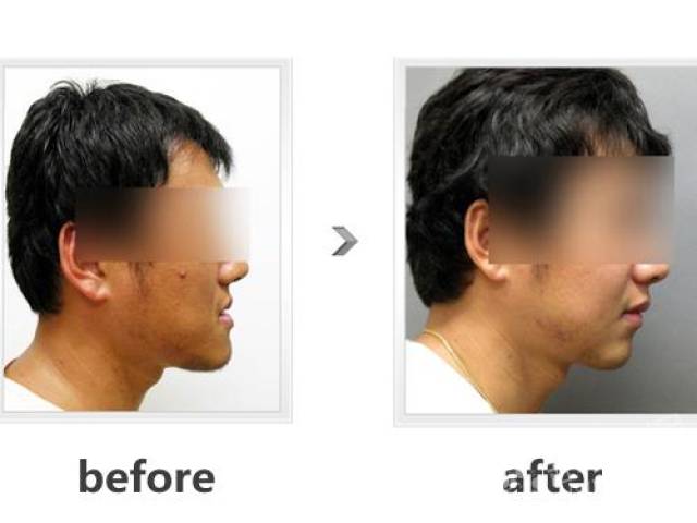 高,幼儿就必须把下颌外伸才能喝到奶,长久以往,下颌就会较上颌更突出