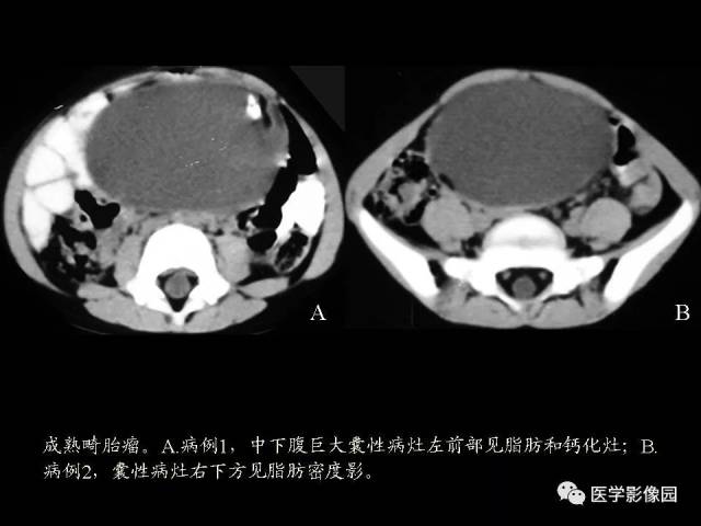 卵巢囊腺瘤ct表现图片图片