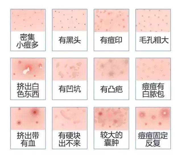 痘痘类型图解 青春期图片