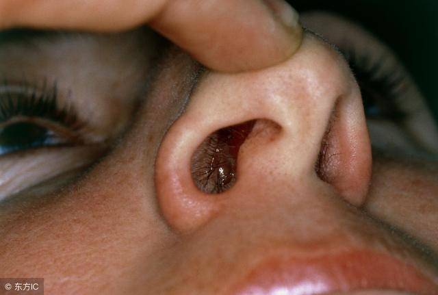 鼻子里面多出来一块肉,是增生还是肿瘤?