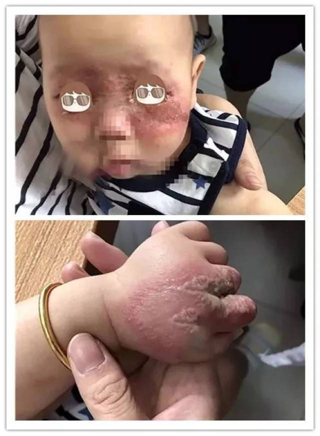 孩子脸上,手上皮肤溃烂,长满水脓包竟是被虫叮!