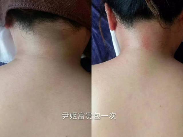 富贵包的重大危害你重视了吗?