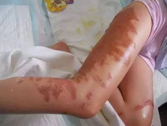 5,厦大白城海域出现小型水母,有人下水游泳后皮肤出现小红点,结果是