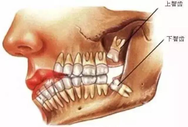 長了智齒一定要拔嗎?