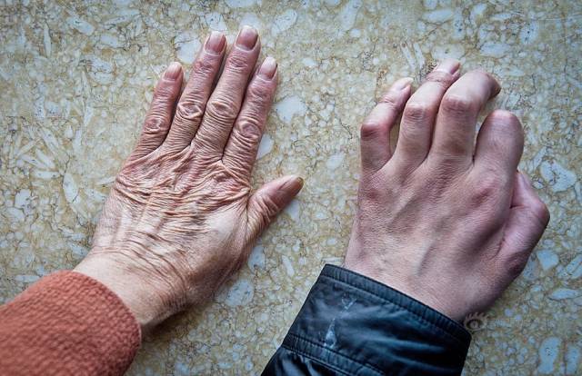 刘洋渐冻症症状及日常代茶饮