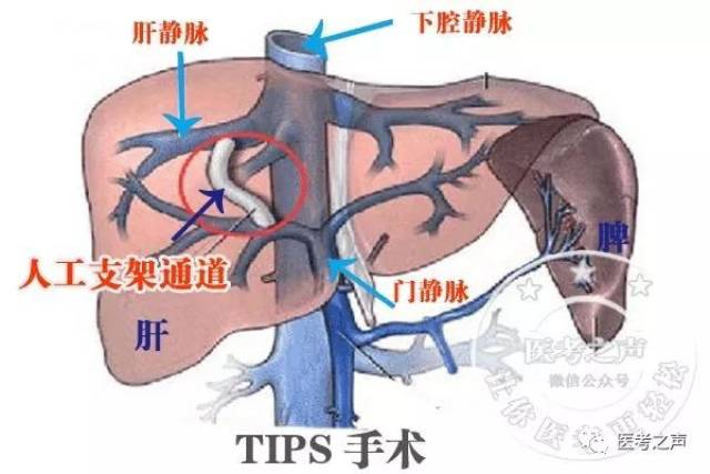 可以採用這個介入手術 (經頸靜脈肝內門體分流術) 名字太長,我們常叫