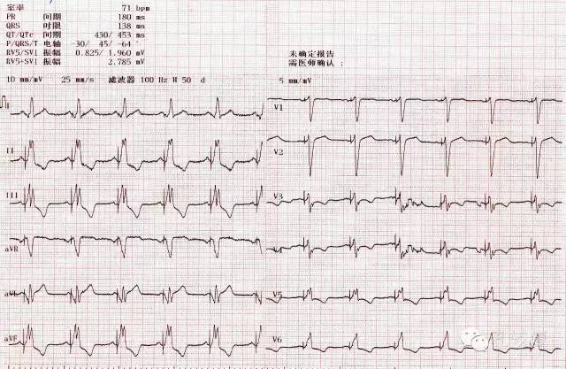 心电向量图图解 报告图片