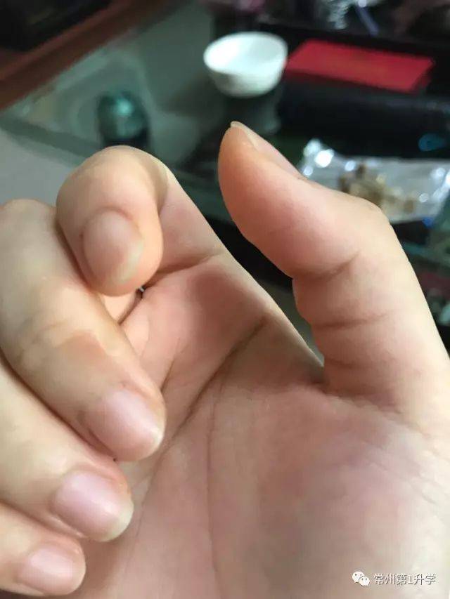 "以前没长过老茧,经历了高三,中指,大拇指长了厚厚的老茧.