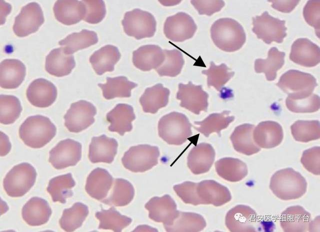 棘形红细胞