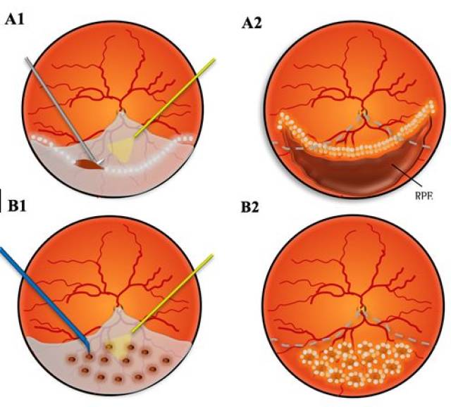 多点电凝视网膜切开术实现少量切开的条件下达到视网膜的复位.