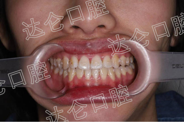 杭州达仑反颌矫正治疗让我告别"地包天",变身自信女神