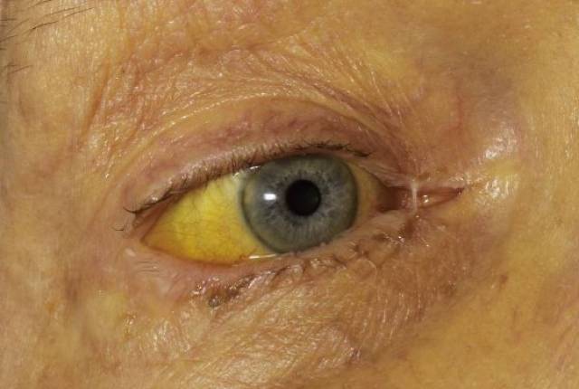 黄疸巩膜黄染图片图片