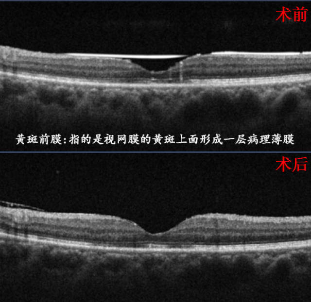 治疗黄斑前膜手术可谓是唯一出路