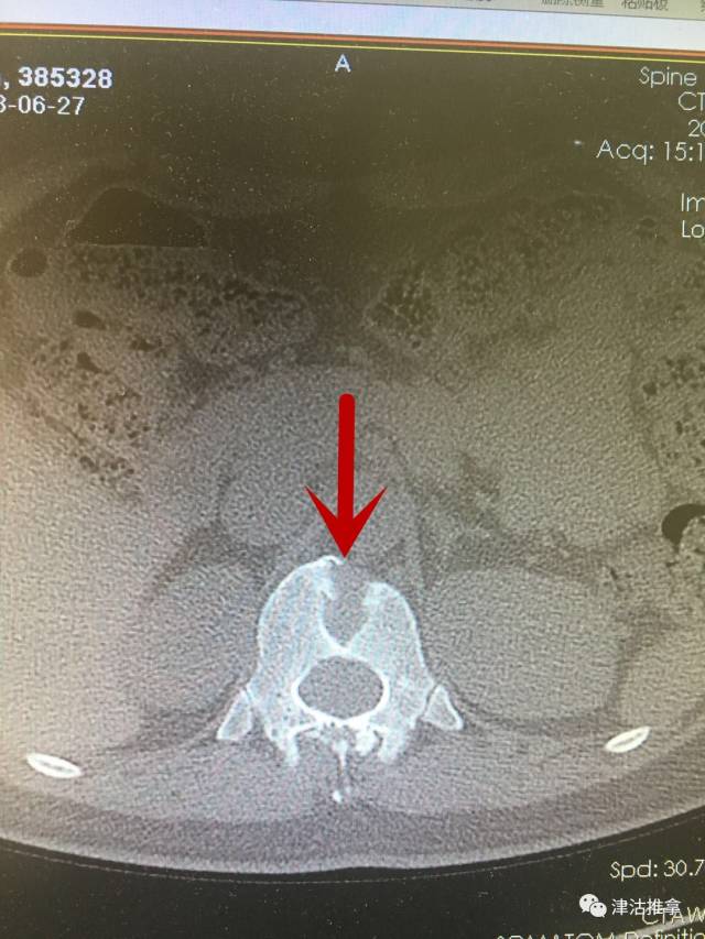 这是什么? 这个蝴蝶椎看着就很可怕,是一种骨折的形态?