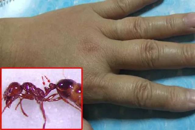 专家建议:被红火蚁咬蛰后,冰敷或冷敷,用肥皂和水清洗患处,局部涂搽