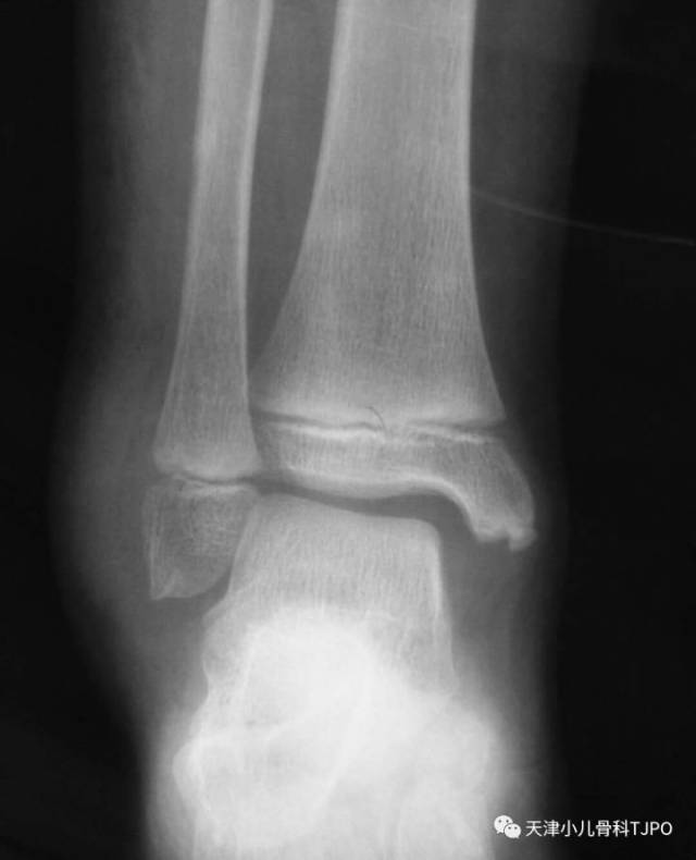 儿童内踝骨骺x线图片图片