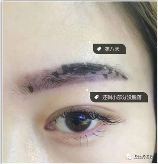 雾眉结痂过程,雾眉结痂蜕变高清图片